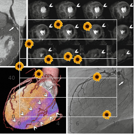 Bilateral renal agenesis