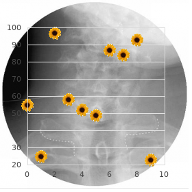 Rubinstein Taybi like syndrome