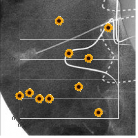 Spastic diplegia infantile type