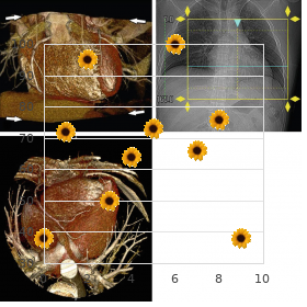 Multiple carboxylase deficiency, late onset