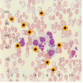 Nijmegen breakage syndrome