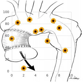 Hyperbilirubinemia transient familial neonatal