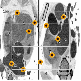 Trichomegaly retina pigmentary degeneration dwarfi