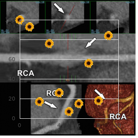 Cardiac amyloidosis