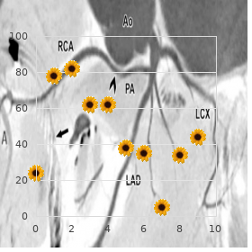 Patau syndrome