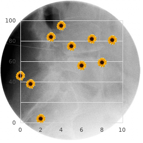 Chromosome 1, monosomy 1q4