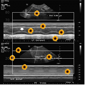 Chromosome 18 mosaic monosomy