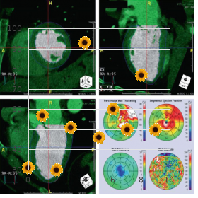 3-M syndrome, rare (NIH)
