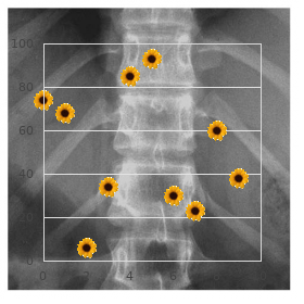 Blepharo facio skeletal syndrome