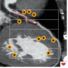 Adrenal hyperplasia