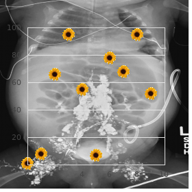 3-M syndrome, rare (NIH)