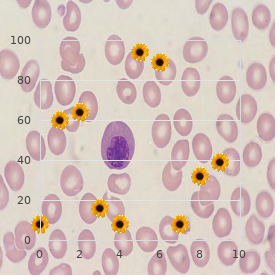 Ventricular extrasystoles perodactyly Robin sequence