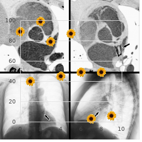 Fetal aminopterin syndrome