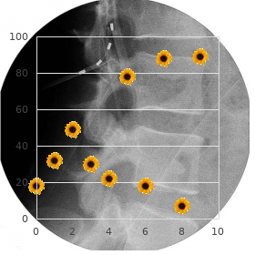 Radial ray hypoplasia choanal atresia