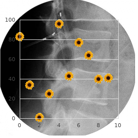 Absence of tibia with polydactyly