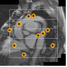 Diabetes persistent mullerian ducts