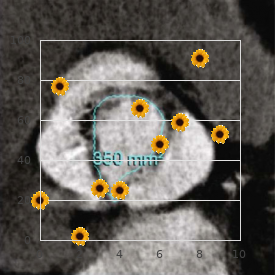 Osmed syndrome