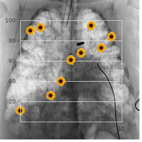 McGillivray syndrome