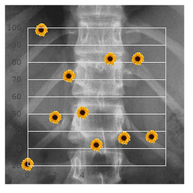 Polyostotic fibrous dysplasia