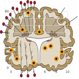 Martsolf syndrome