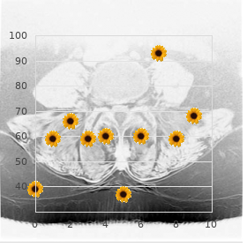 Spinocerebellar ataxia dysmorphism