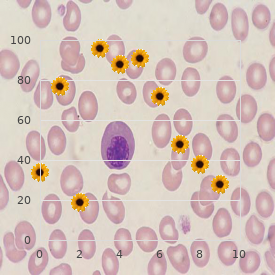 Camptodactyly fibrous tissue hyperplasia skeletal dysplasia