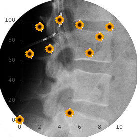 Camptodactyly joint contractures facial skeletal dysplasia