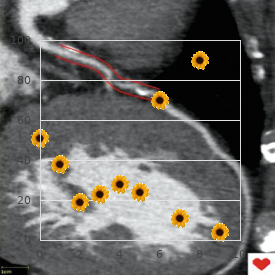 Growth retardation hydrocephaly lung hypoplasia