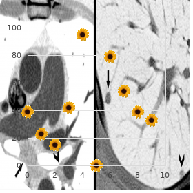 Letterer Siwe disease