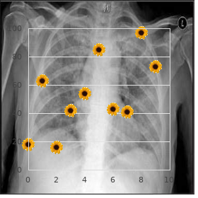 Pyruvate carboxylase deficiency