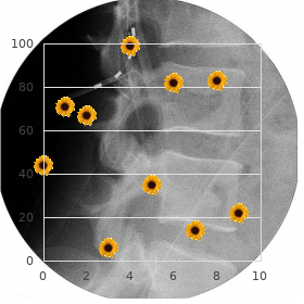 Retinitis pigmentosa-deafness