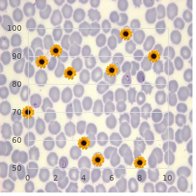 Lundberg syndrome