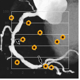 Epimetaphyseal dysplasia cataract