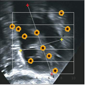 Tethered spinal cord disease