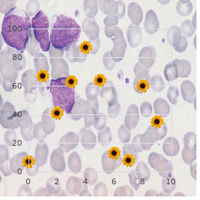 Coloboma of macula