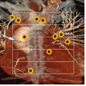 Emphysema, congenital lobar