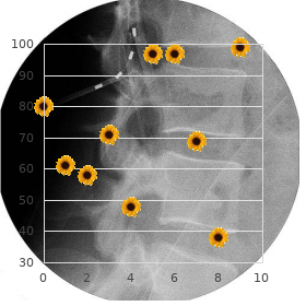 Spastic paraplegia type 4, dominant