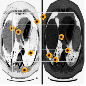 Kearns Sayre syndrome