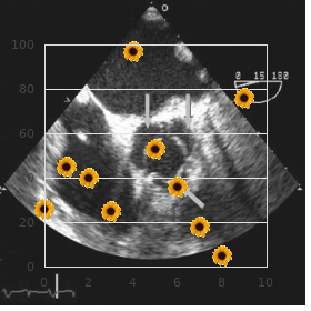 Thiopurine S methyltranferase deficiency