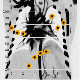 Al Gazali Hirschsprung syndrome