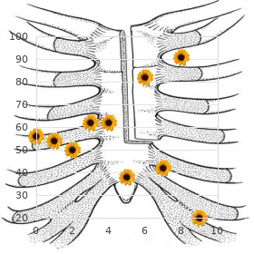 Stevens Johnson syndrome