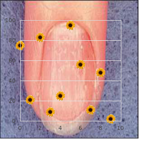 Turner Kieser syndrome