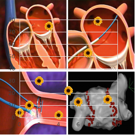 Craniostenosis with congenital heart disease mental retardation