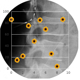 Langerhans cell granulomatosis