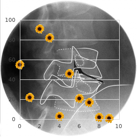 Weismann Netter Stuhl syndrome