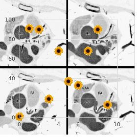 Tuffli Laxova syndrome