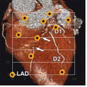 Hyperaldosteronism
