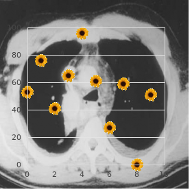Malignant paroxysmal ventricular tachycardia