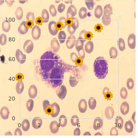 Macroglobulinemia