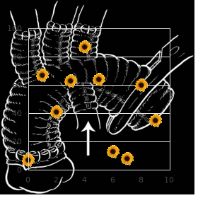 Cantu Sanchez Corona Fragoso syndrome